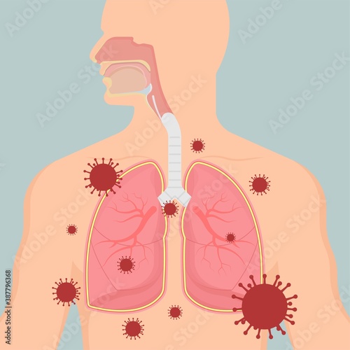 Acute respiratory distress syndrome (ARDS) a respiratory failure and inflammation in the lungs equipment hospital Emphysema fibrosis idiopathic Cystic Collapsed pneumothorax embolism