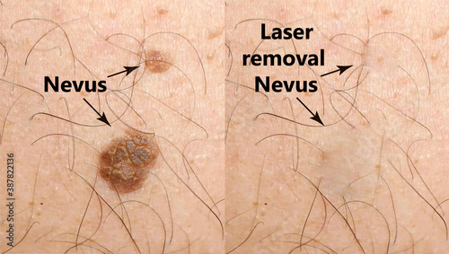 Brown spot on the skin. Pigmented spots and moles. Mole and skin hair.