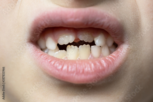 close-up on the lower part of the child's face, 7 year old toddler girl or boy shows milk teeth and growing permanent. Soft selective focus. Macro. Child health and development concept, dentistry