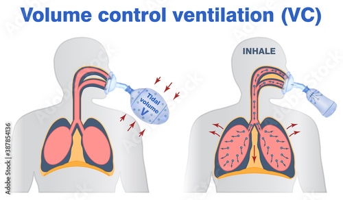 Illustration of vollume control or support artifitial ventilation. Tidal volume, mask ventilation, breathing resuscitator bag ventilation. photo