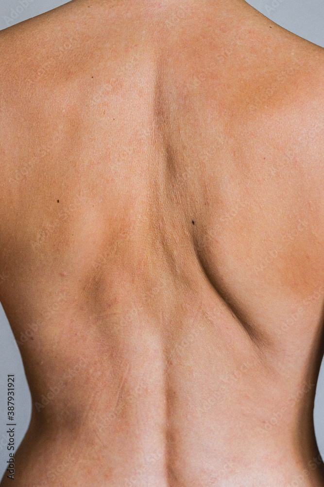 Fototapeta premium Psoriasis skin disease is a dermatic problem, red allergic skin rash.