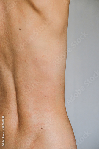 Psoriasis skin disease is a dermatic problem, red allergic skin rash.