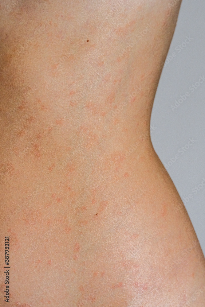 Psoriasis skin disease is a dermatic problem, red allergic skin rash.