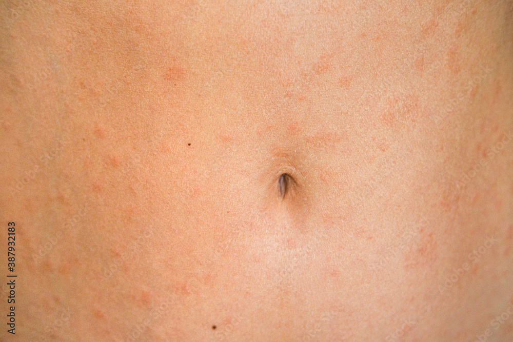 Psoriasis skin disease is a dermatic problem, red allergic skin rash. Psoriasis skin disease is a dermatic problem, red allergic skin rash.