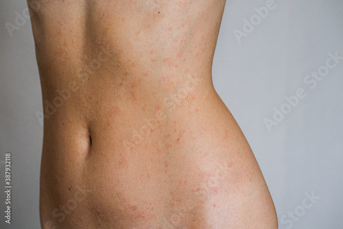 Psoriasis skin disease is a dermatic problem, red allergic skin rash.