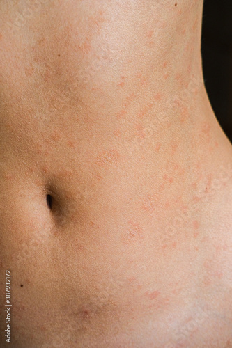 Psoriasis skin disease is a dermatic problem, red allergic skin rash.