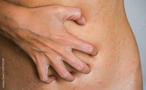 Psoriasis skin disease is a dermatic problem, red allergic skin rash.