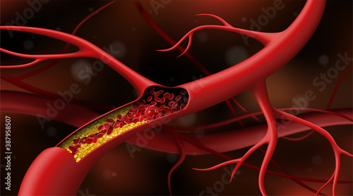 Artery blocked by cholesterol. Vector illustration
