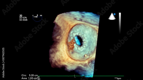 3D image of the heart during transesophageal ultrasound.