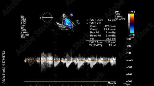 Image of the heart during transesophageal ultrasound with Doppler mode.