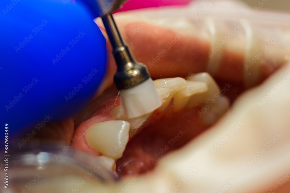 The dentist polishes the teeth with a drill, a dental procedure. Teeth polishing macro. The dentist polishes the teeth with a drill, a dental procedure. Teeth polishing macro.
