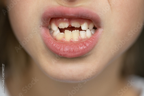 Wallpaper Mural close-up on the lower part of the child's face, 7 year old toddler girl or boy shows milk teeth and growing permanent. Soft selective focus. Macro. Child health and development concept, dentistry Torontodigital.ca