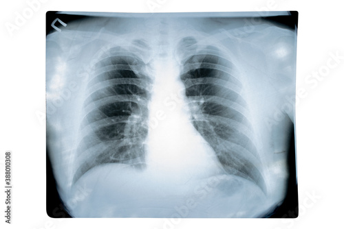 Chest x-ray checking the level of lung damage