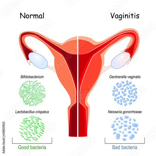 Vaginal flora. Good and bad bacteria that colonize vagina. photo