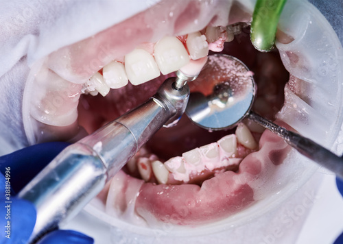 Close up view on cleaning teeth of patient with cheek retractor in mouth and brackets on teeth with a help of tooth brush, mechanical brush, mirror and saliva ejector. Dental procedures concept