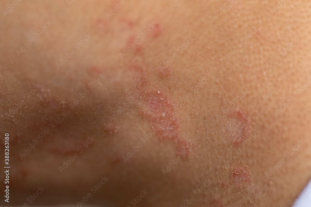 Fototapeta premium Tinea circinata or ringworm on the head. 