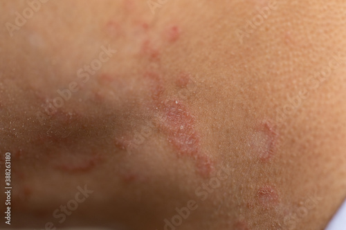 Tinea circinata or ringworm on the head.
