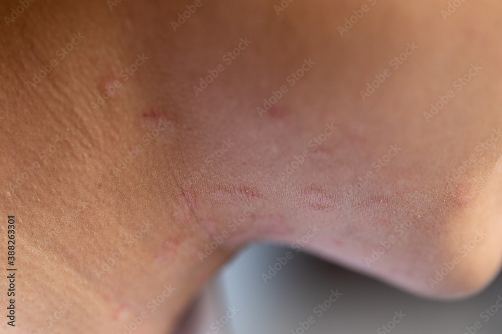 Fototapeta premium Tinea circinata or ringworm on the head. 