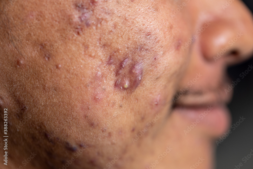 Backgrounds of lesions skin caused by acne on the face in the clinic.
