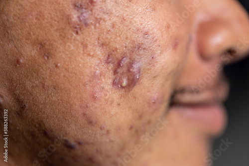 Backgrounds of lesions skin caused by acne on the face in the clinic. 