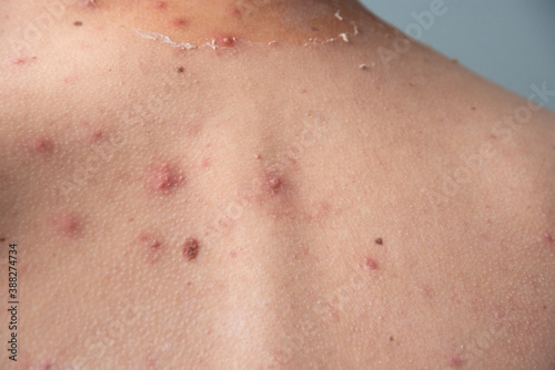 closeup a man back who having varicella blister or chickenpox