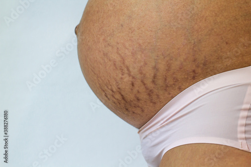 Pregnant belly with stretch marks, cracks skin texture close up.