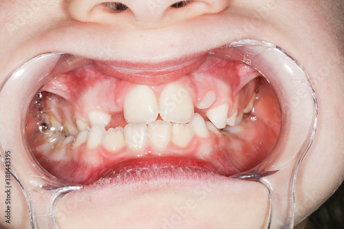 Dental displacement, which needs orthodontic treatment