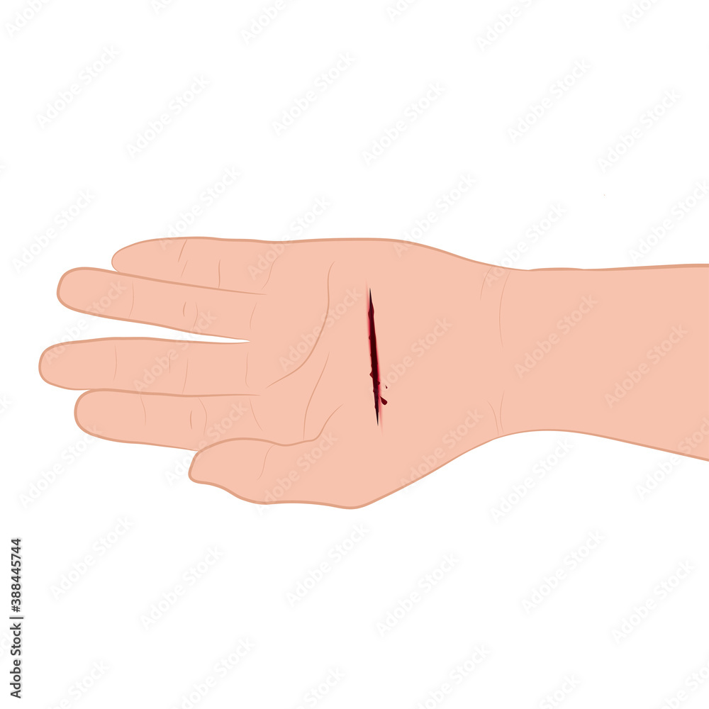 injured hand with bleeding gash with wound on the hand palm vector illustration injured hand with bleeding gash with wound on the hand palm vector illustration
