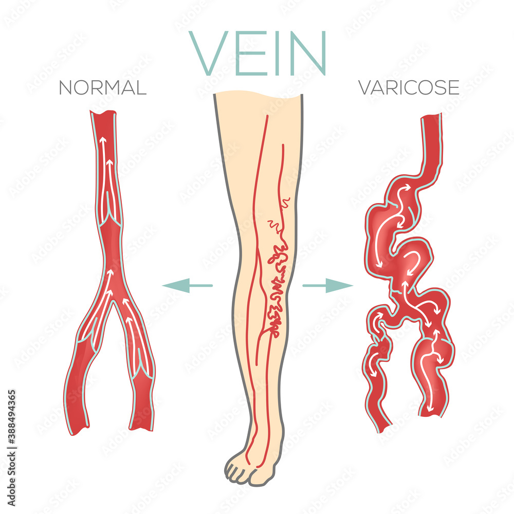 Varicose veins, large, swollen vein on the legs and feet. Valves do not work, blood does not