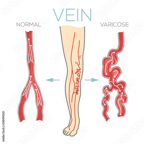 Varicose veins, large, swollen vein on the legs and feet. Valves do not work, blood does not flow effectively. Medical schematic vector illustration.