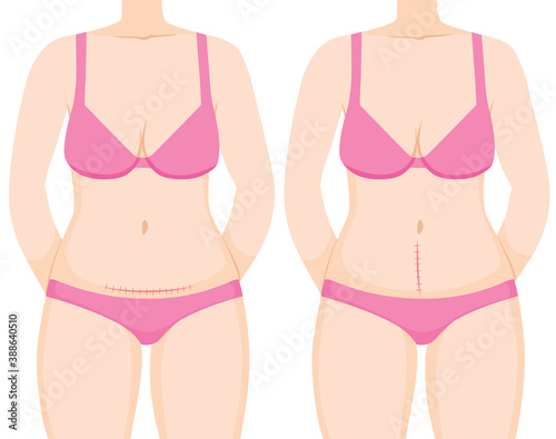 Woman body showing c section cesarean operation with vertical and horizontal scar