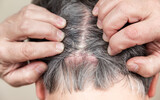 Head psoriasis. Head psoriasis. Psoriasis Vulgaris, psoriatic skin disease in hair, skin patches are typicaly red, itchy, and scaly, macro with narrow focus.