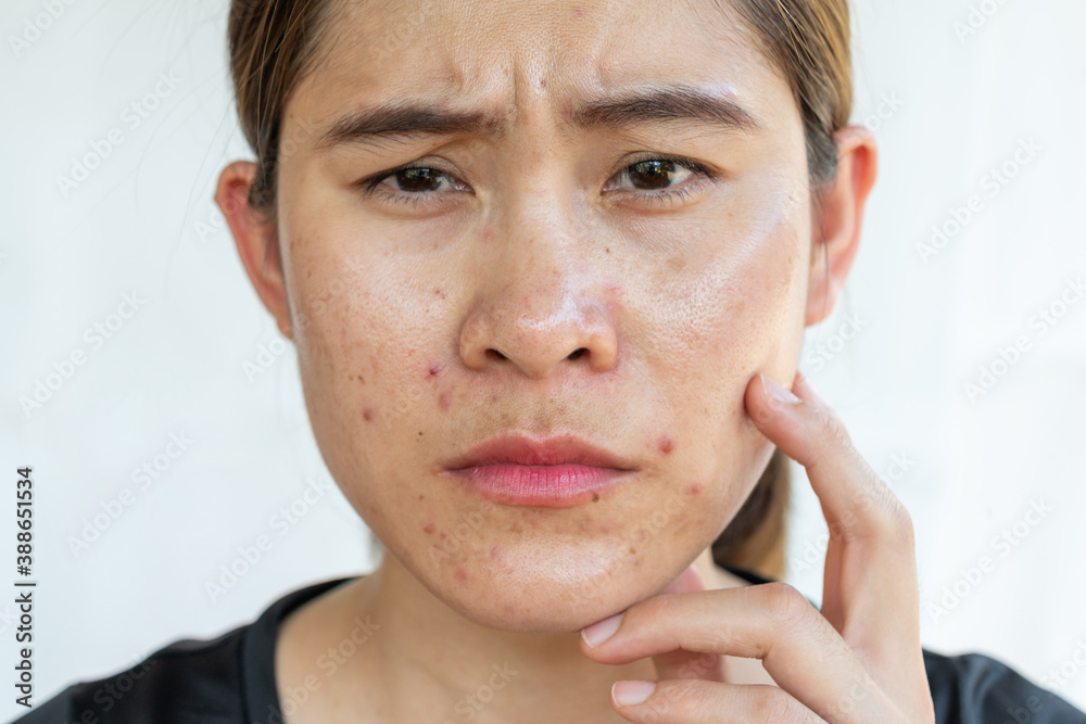 Obraz premium Worried woman having problems of acne inflamed on her face. Inflamed acne consists of swelling, redness, and pores that are deeply clogged with bacteria, oil, and dead skin cells.