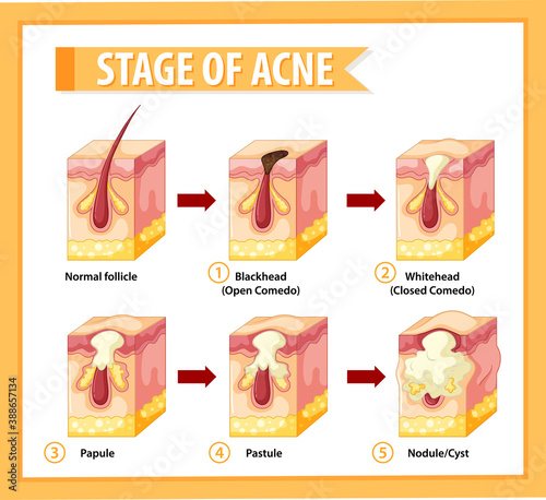 Stages of skin acne anatomy