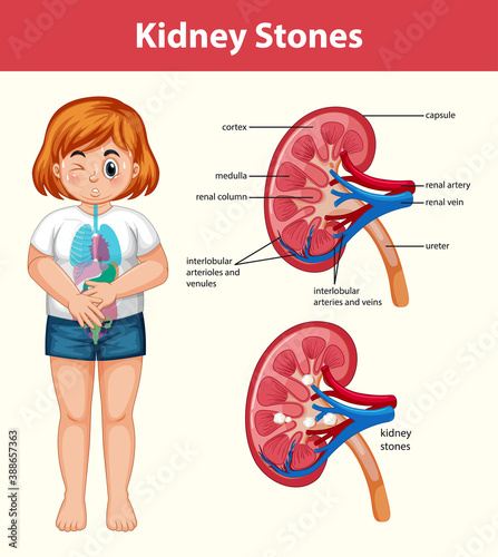 Human kidney stones cartoon style infographic
