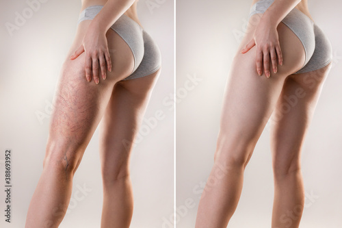 Medicine and varicose veins. A young woman of athletic build is holding her leg with her hand, with a varicose mesh on her thigh. Before and after