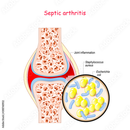 Septic arthritis. Close-up of bacteria S. aureus, E. coli