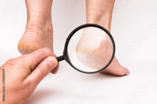 Highly dry heels woman on a white background closeup through a magnifying glass