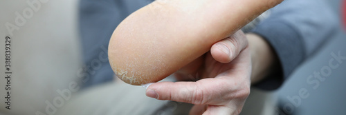 Close-up of man applying moisturizing lotion on problem areas on skin. Barefoot man with unhealthy and unattractive heel. Uncomfortable shoes and damaged foot