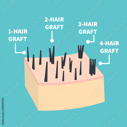 Hair micrograft classification set for hair transplantation surgery. Skin cross-section with number of hairs in the follicular unit or family. Hair science and anatomy. Cartoon vector illustration.