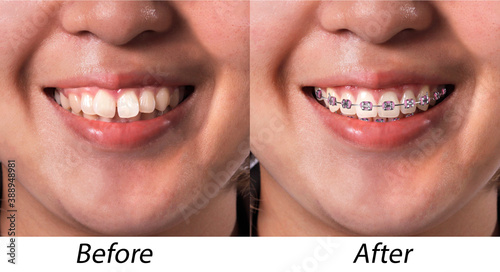 Close up woman smiling with teeth before and after braces treatment.Dental braces Concept.