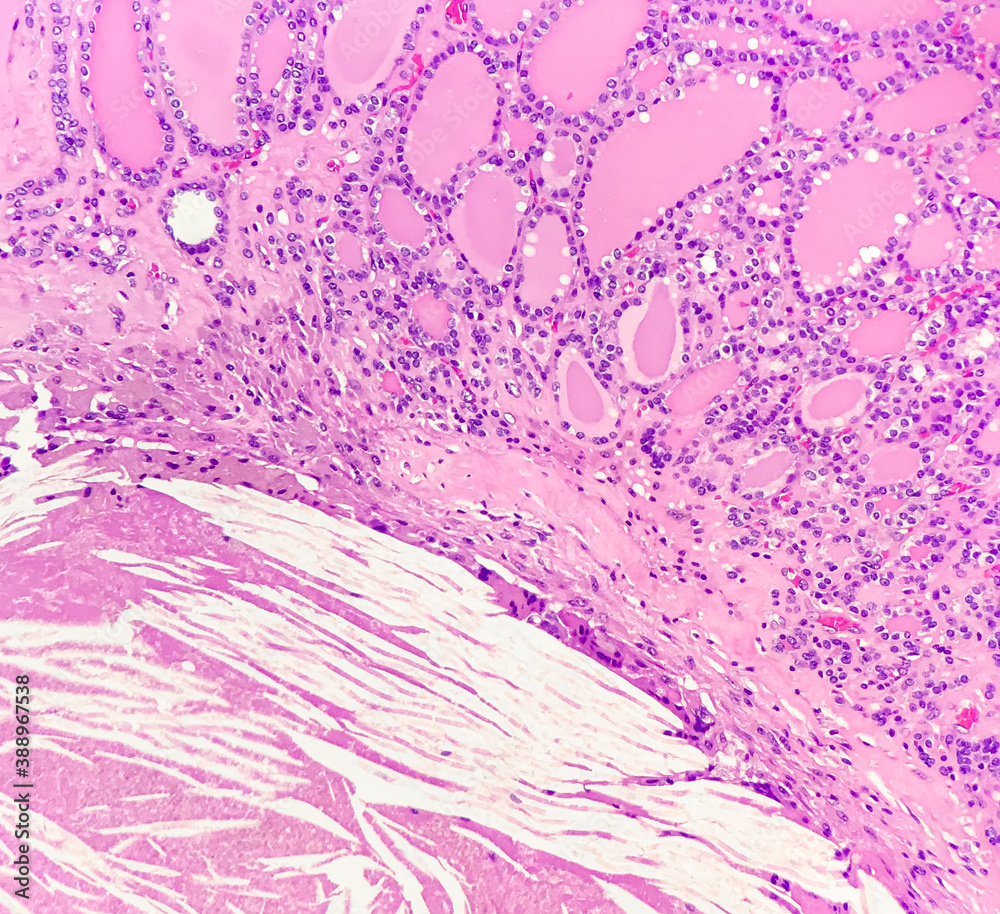 Cholesterol cleft (left lower) and nodular goiter (right upper) in