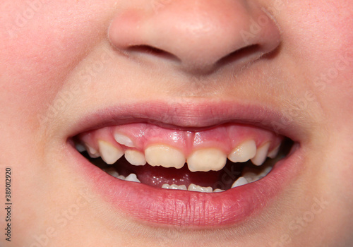 Children's teeth. The molar grows in the second row. Anomalies of tooth growth.