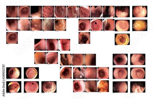 Collection Gastrointestinal endoscopic examination image showing acute on chronic gastritis.Medical healthcare concept.Soft and blurry when views full solution. photo