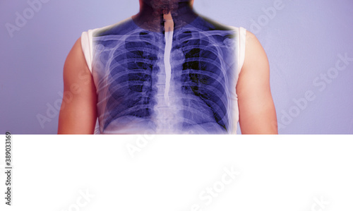Foto Esophagram and Barium swallow AP view Compare after The patient drinks a liquid that contains barium showing esophagus