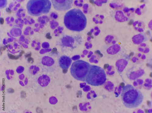 Mesothelial cells in body fluid sample.