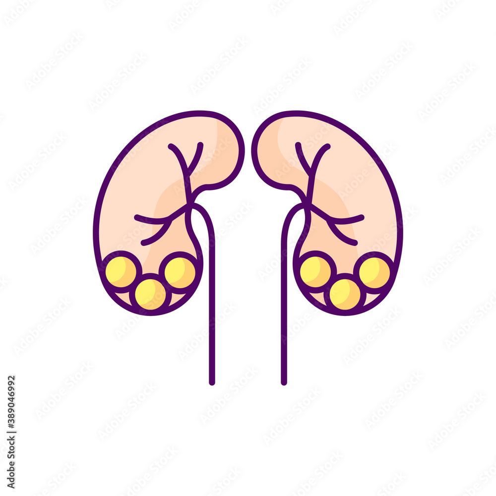 Kidney stone disease RGB color icon. Dissolved minerals and salts. Urolithiasis. Blocked ureter. Waste products in blood. Bladder. Urinary tract. Small pebbles. Isolated vector illustration Kidney stone disease RGB color icon. Dissolved minerals and salts. Urolithiasis. Blocked ureter. Waste products in blood. Bladder. Urinary tract. Small pebbles. Isolated vector illustration