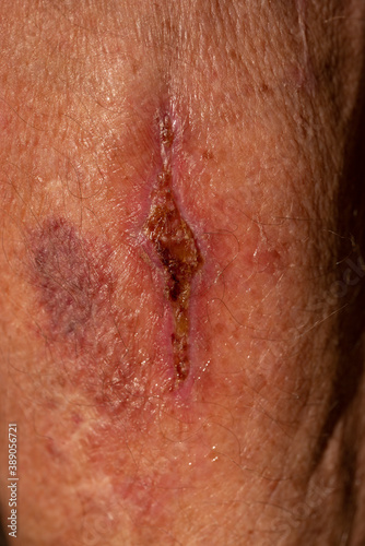 Obraz na plátně Closeup of scab on bruised skin