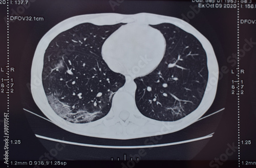 Spiral computed tomography of the lungs. Bilateral viral pneumonia COVID-19, 20 and 25% of the lesion.