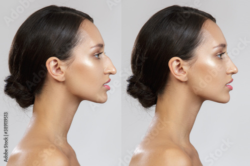 Foto Comparison of the female nose after plastic surgery